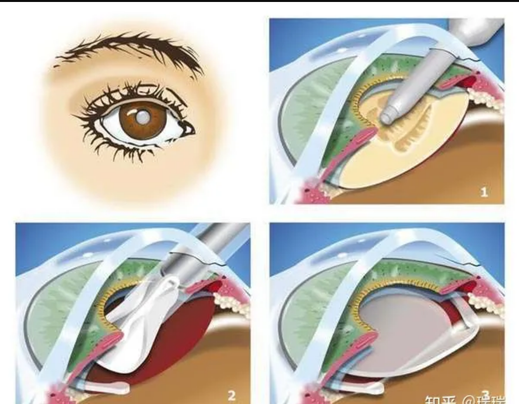 白内障超声乳化手术图例.png