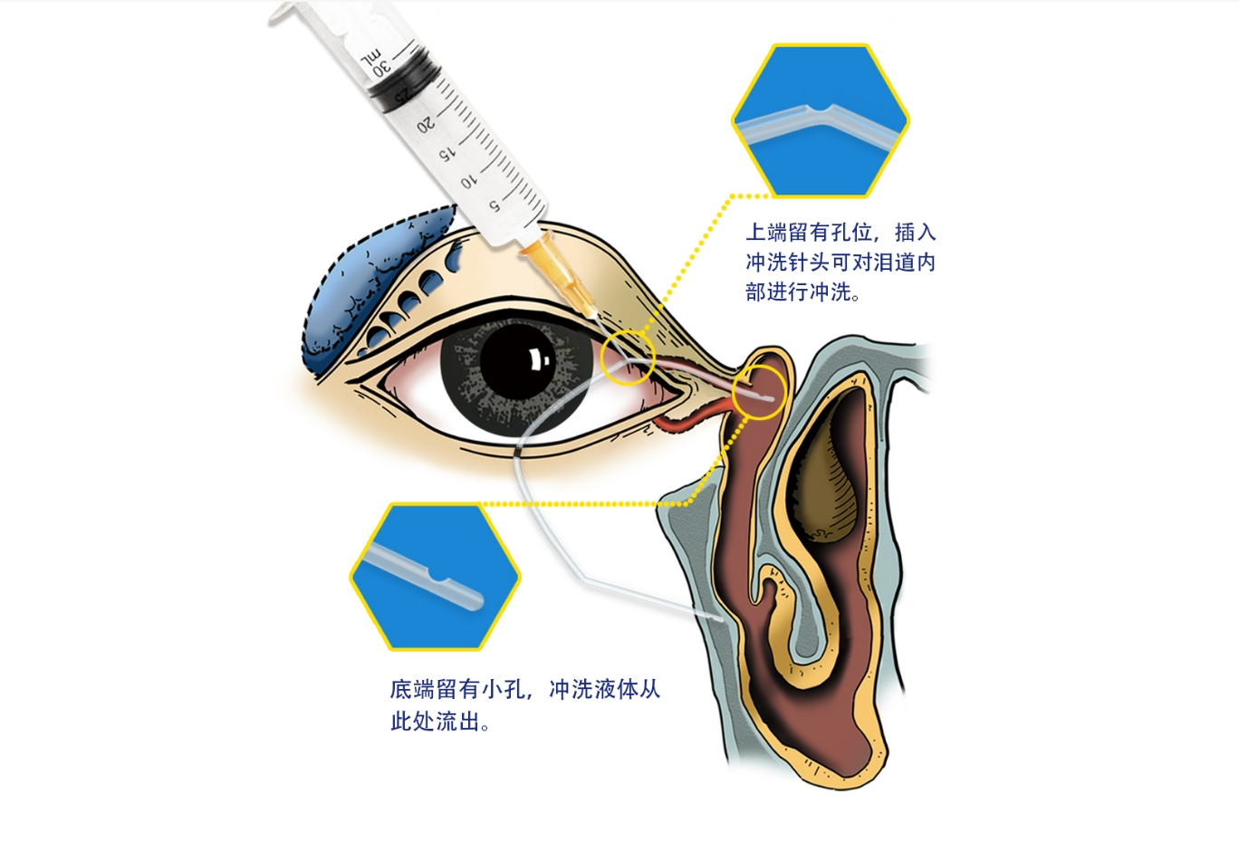 泪道冲洗示意图.png